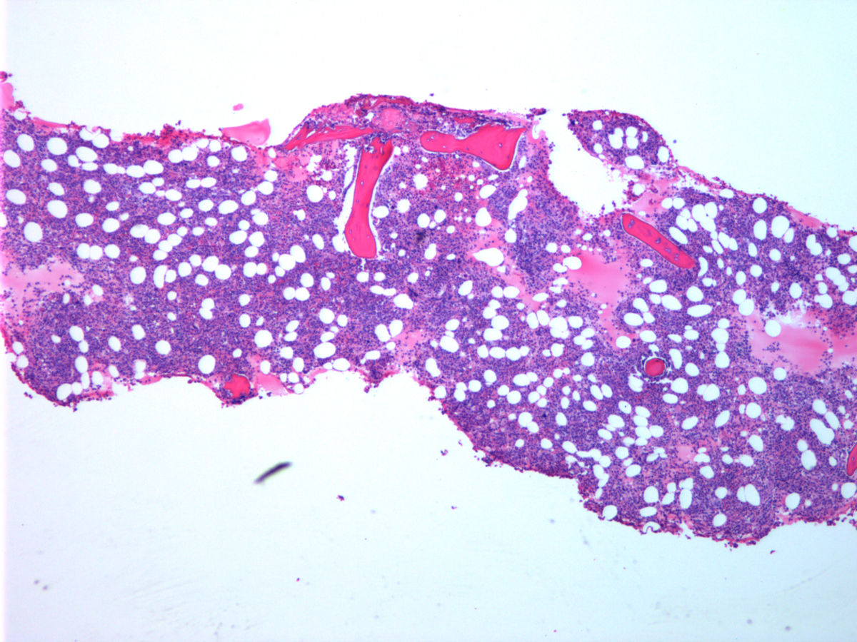 Bone marrow biopsy (low power)